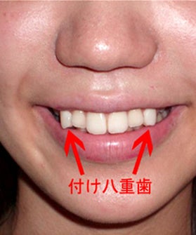 snaggletooth-beauty-trend-main