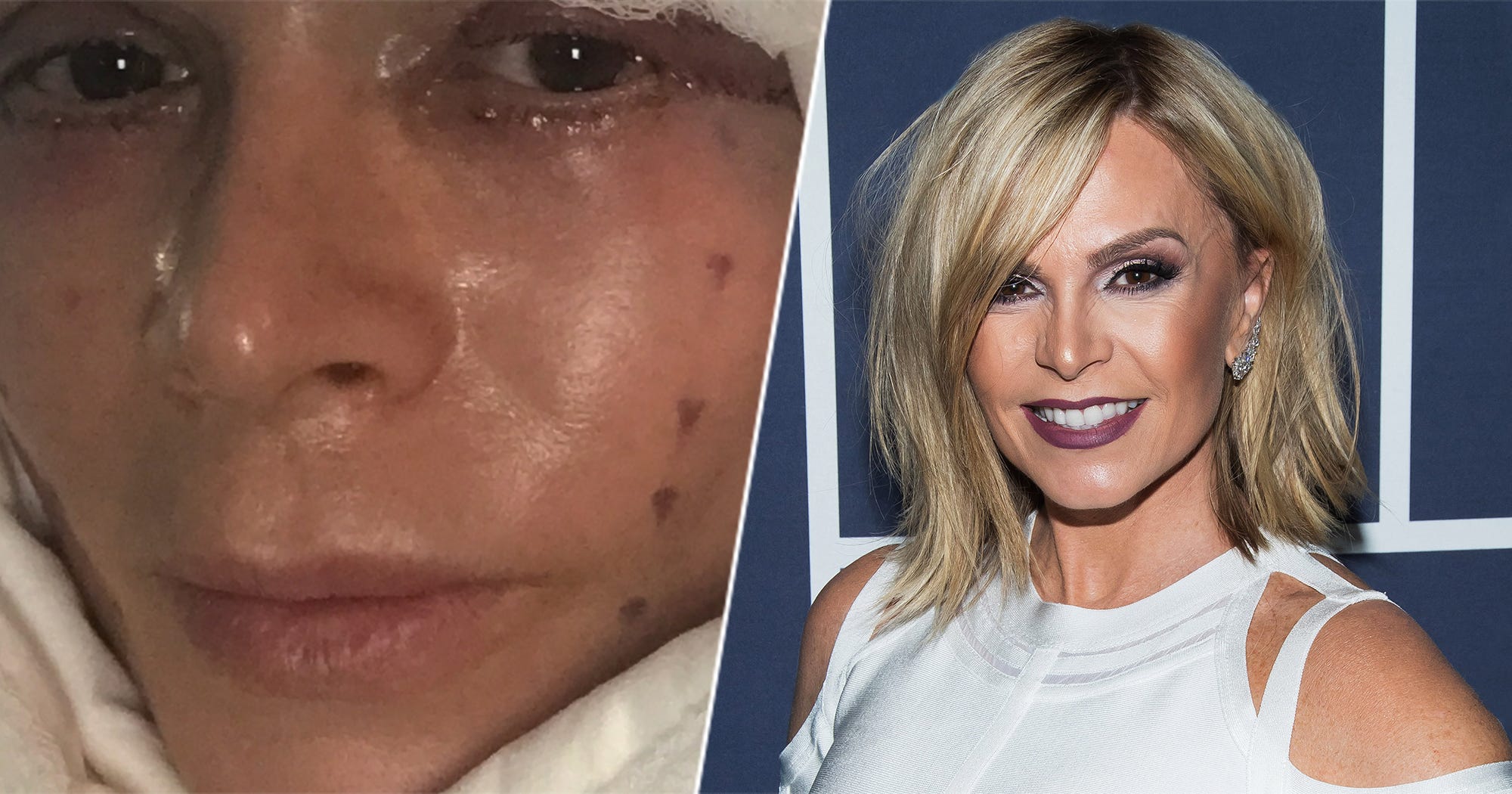 Tamra Judge Facelift - Real Housewives Plastic Surgery