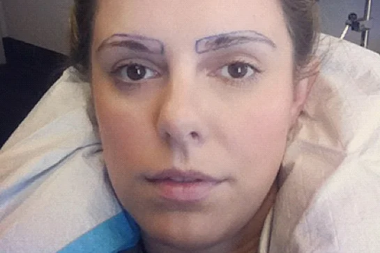 eyebrow transplants brow restoration