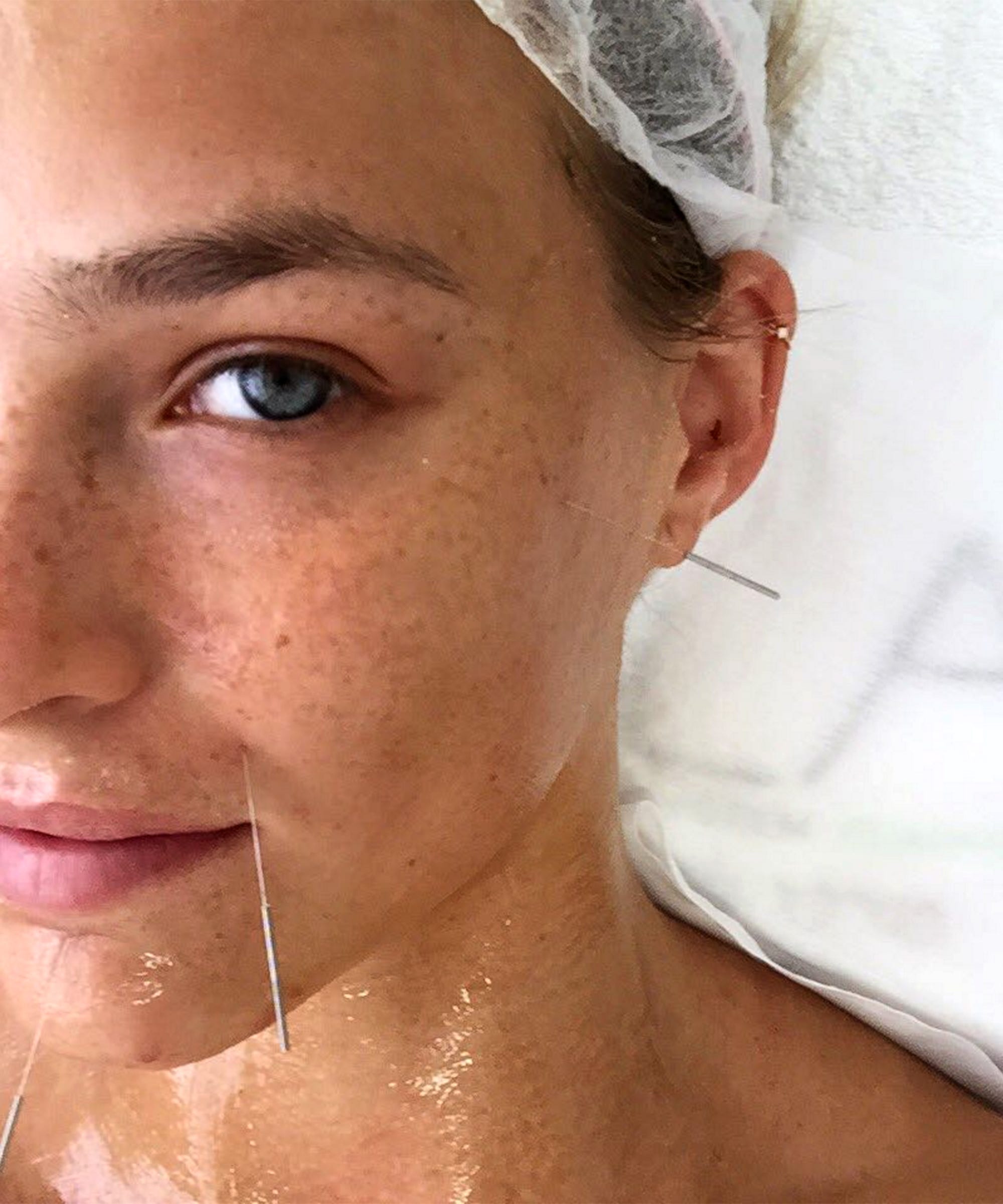 Tried Tested: Facial Acupuncture Tried Tested: Facial Acupuncture new pics Tried Tested: Facial Acupuncture Tried Tested: Facial Acupuncture new images
