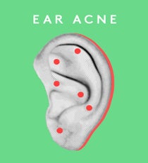EarAcne_opener_V4