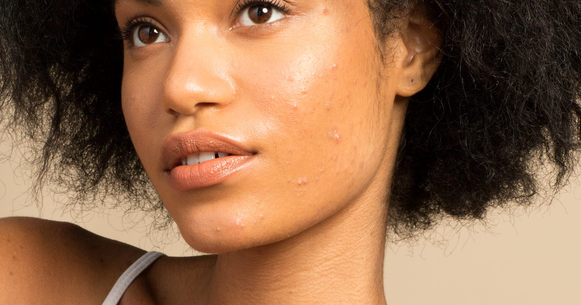 How My Adult Acne Affected My Dating Life