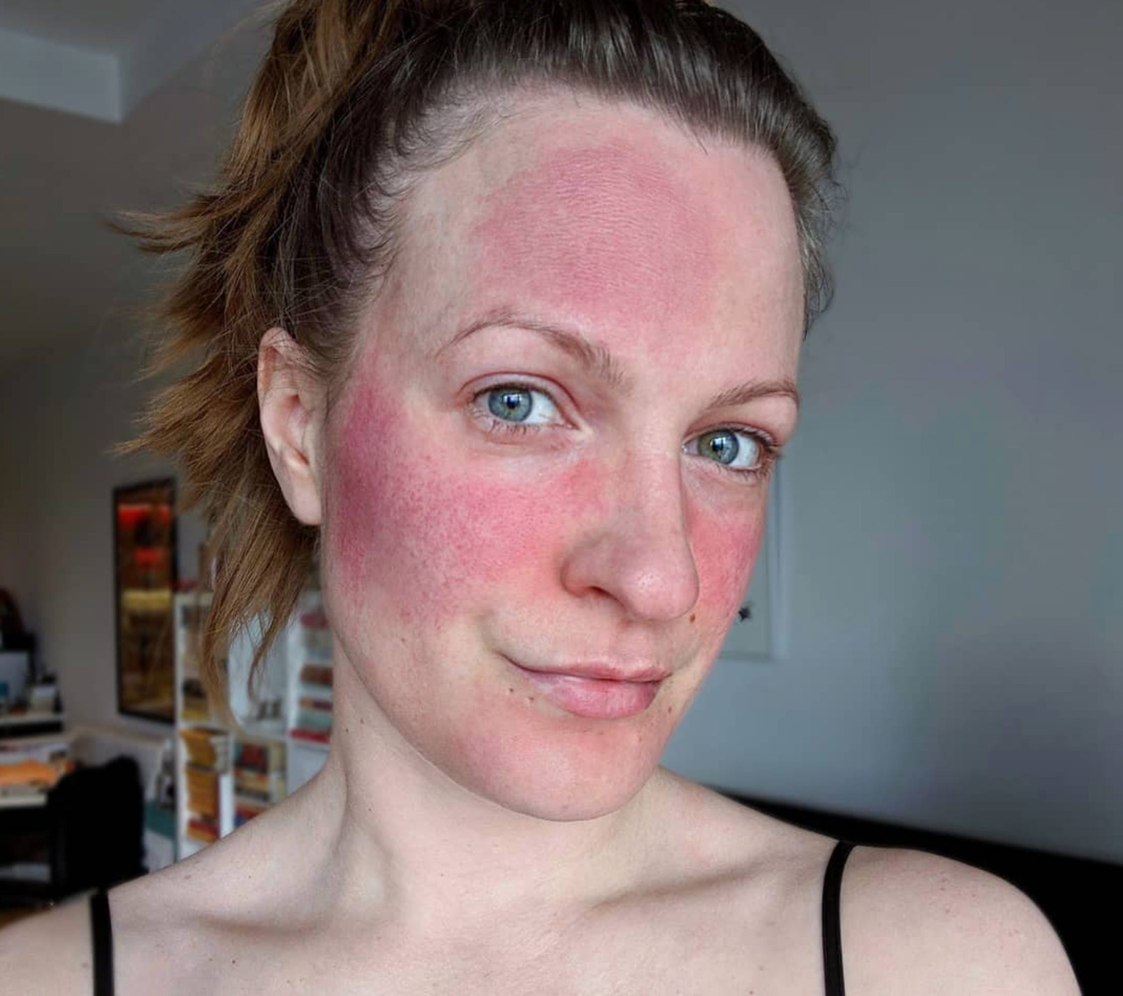 15 Best Rosacea Creams for Redness (Dermatologist Reviewed 2024)