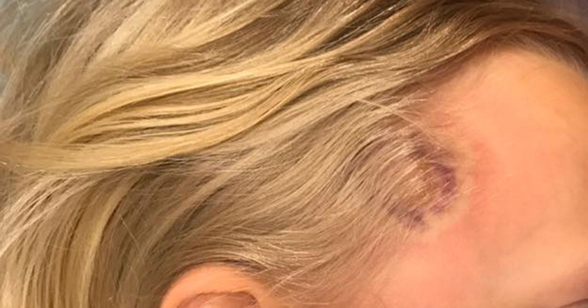 Rare Lyme Disease Symptoms Viral Photo Mom Warning
