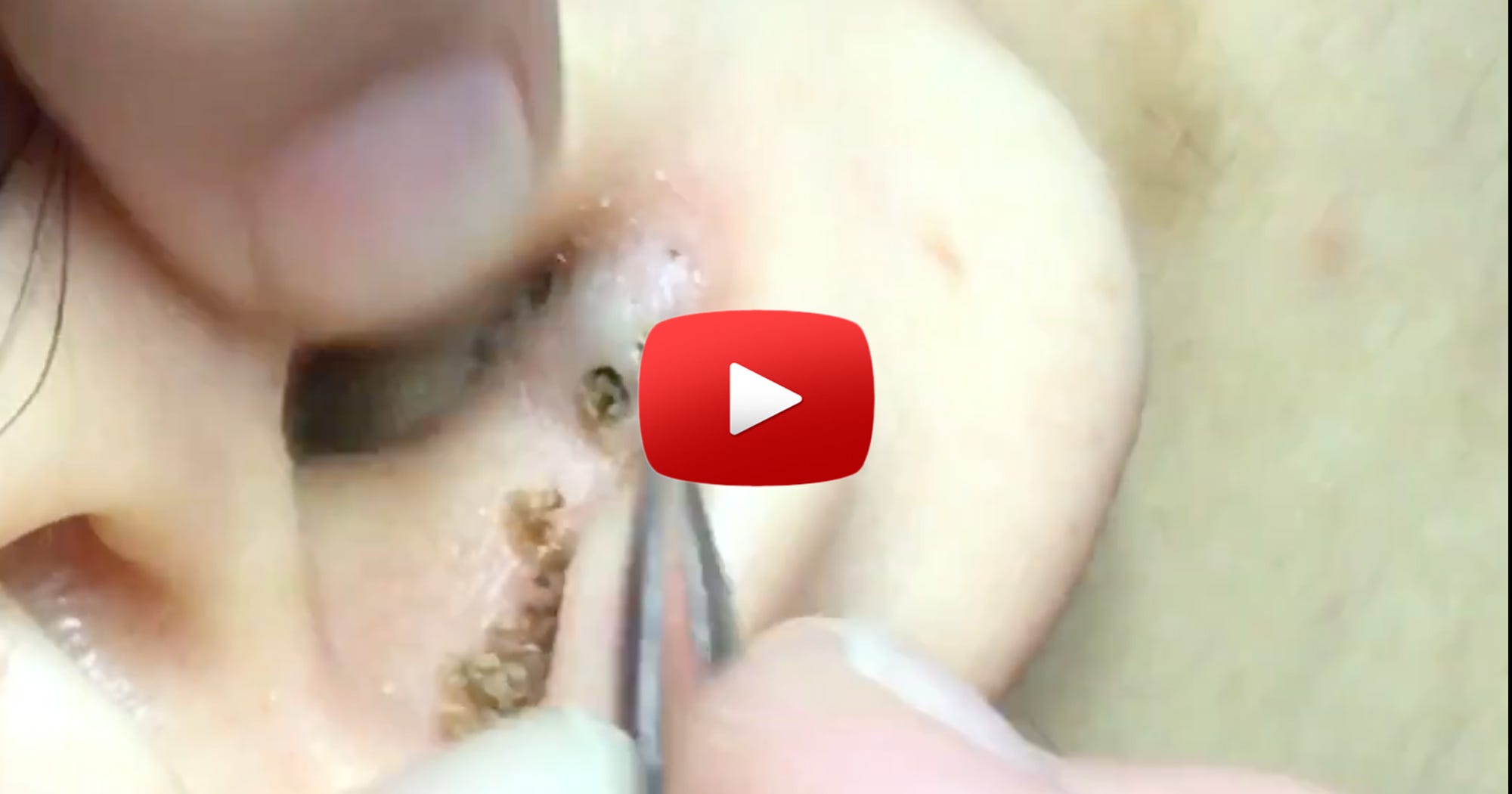 Ear Blackhead Removal Video Viral Reddit Beauty Thread