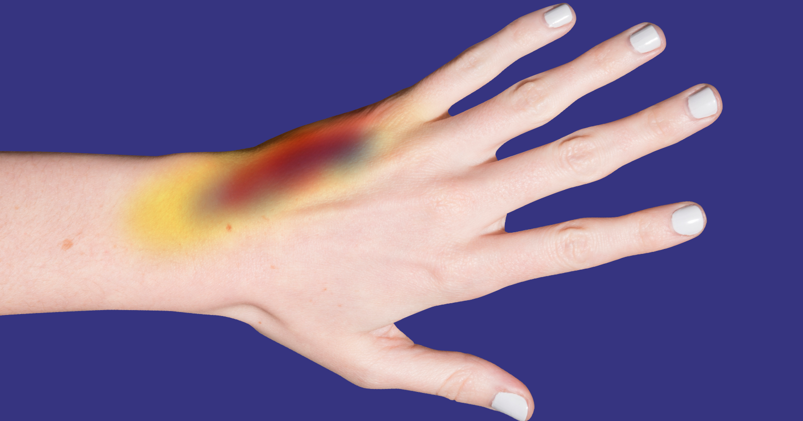 Wie Füge Ich Mir Schnell Blaue Flecken Zu Warum kriege ich schnell blaue Flecken?